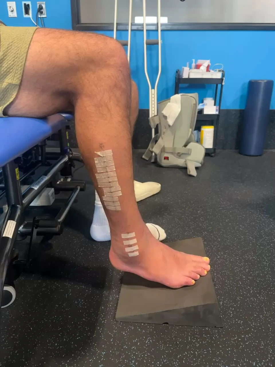 Post-operative lower leg with steri-strips during early rehabilitation